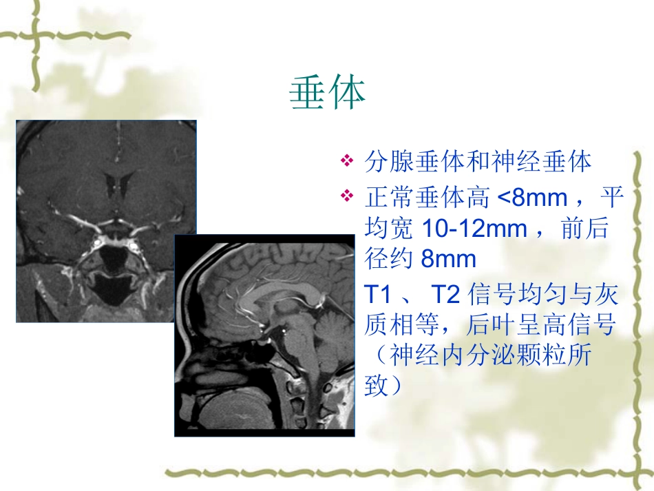 鞍区肿瘤影像表现PPT_第4页
