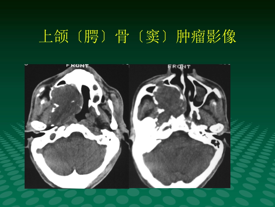 鼻咽肿块的临床与影像_第10页