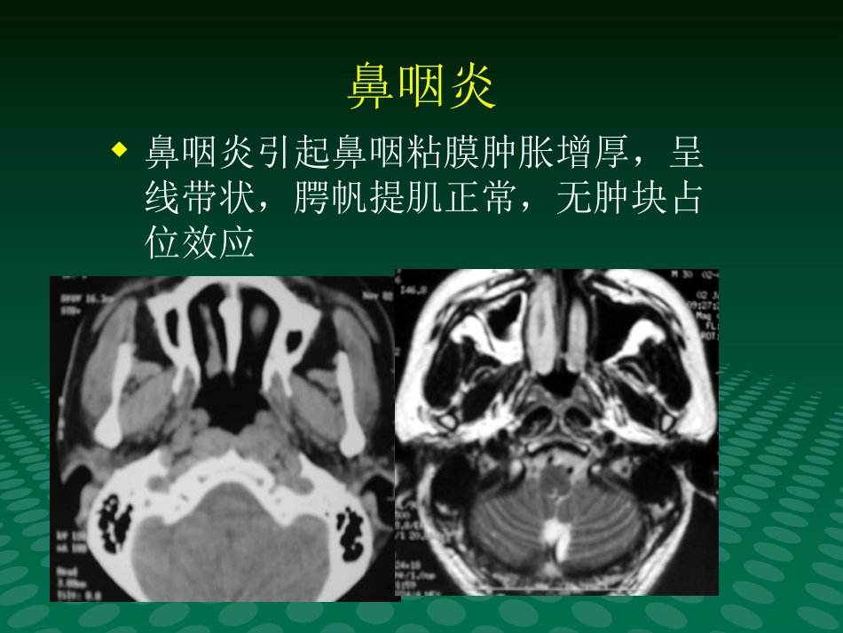 鼻咽肿块的临床与影像_第13页