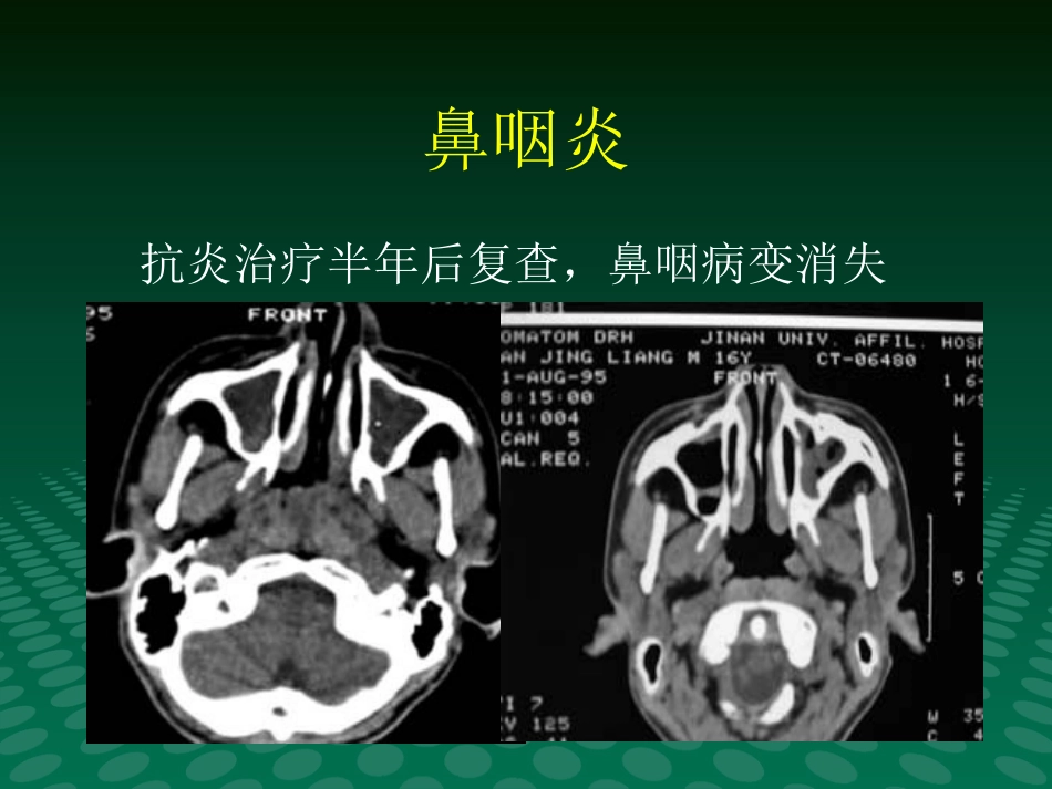 鼻咽肿块的临床与影像_第14页