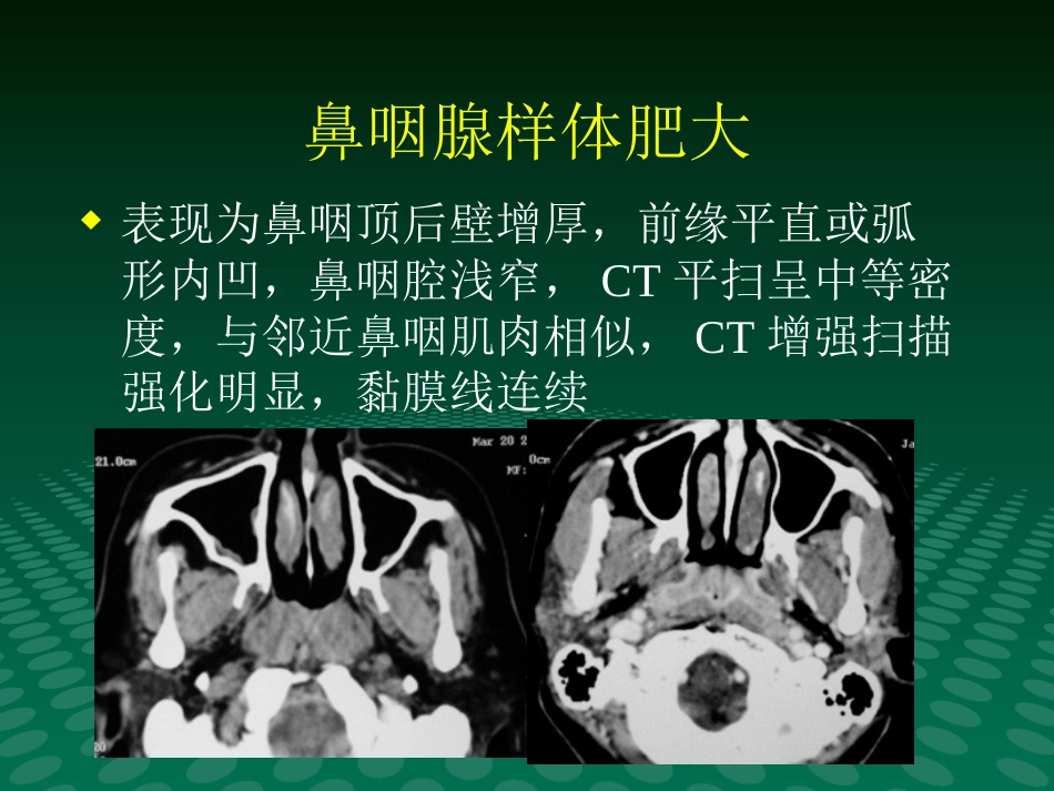 鼻咽肿块的临床与影像_第15页