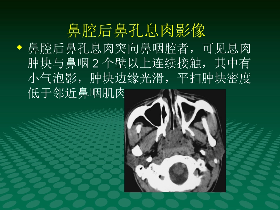 鼻咽肿块的临床与影像_第4页