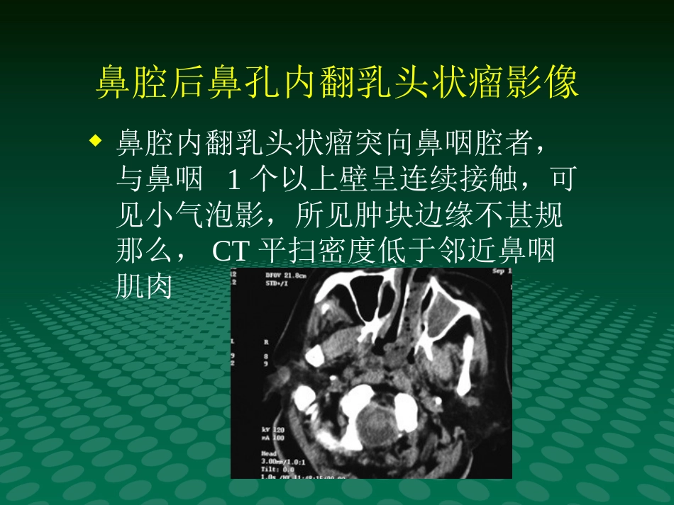 鼻咽肿块的临床与影像_第5页