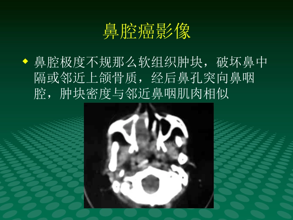 鼻咽肿块的临床与影像_第8页