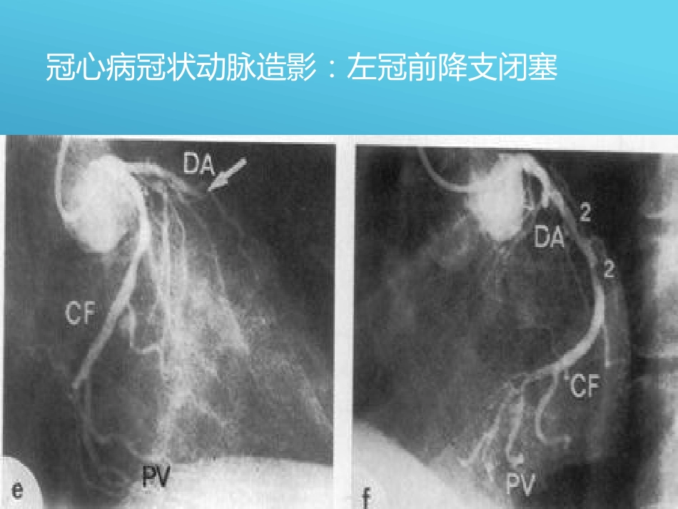 常见心脏疾病的X线影像XR诊断_第10页