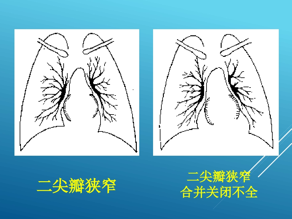 常见心脏疾病的X线影像XR诊断_第14页