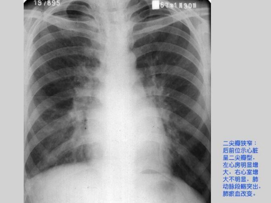 常见心脏疾病的X线影像XR诊断_第15页