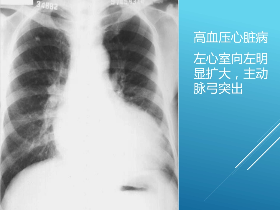 常见心脏疾病的X线影像XR诊断_第5页