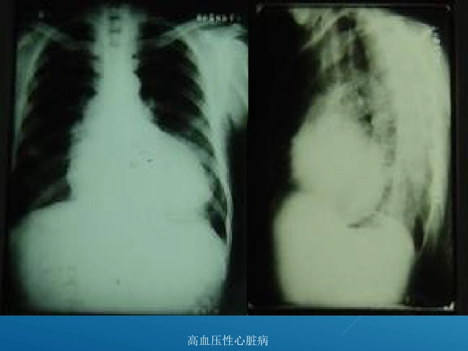 常见心脏疾病的X线影像XR诊断_第6页