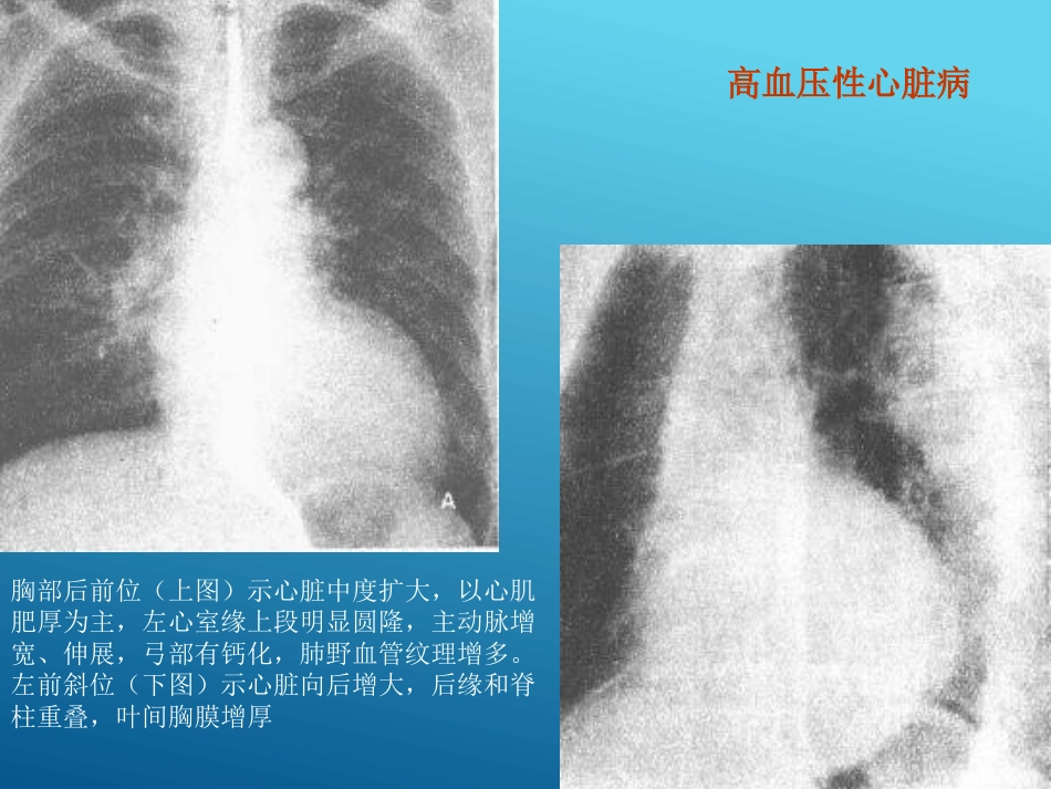 常见心脏疾病的X线影像XR诊断_第7页