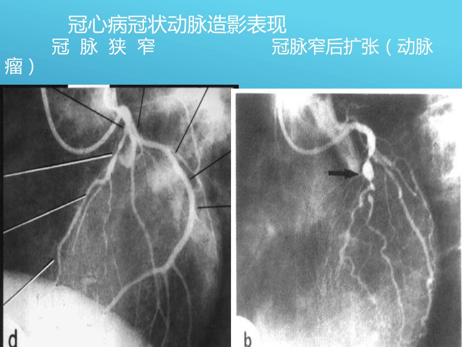 常见心脏疾病的X线影像XR诊断_第9页