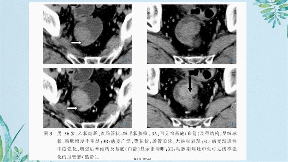 肠腺瘤影像_第10页