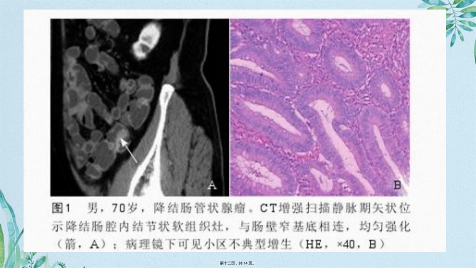 肠腺瘤影像_第12页