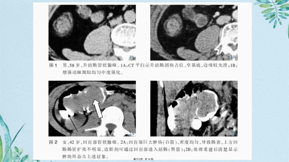 肠腺瘤影像_第13页