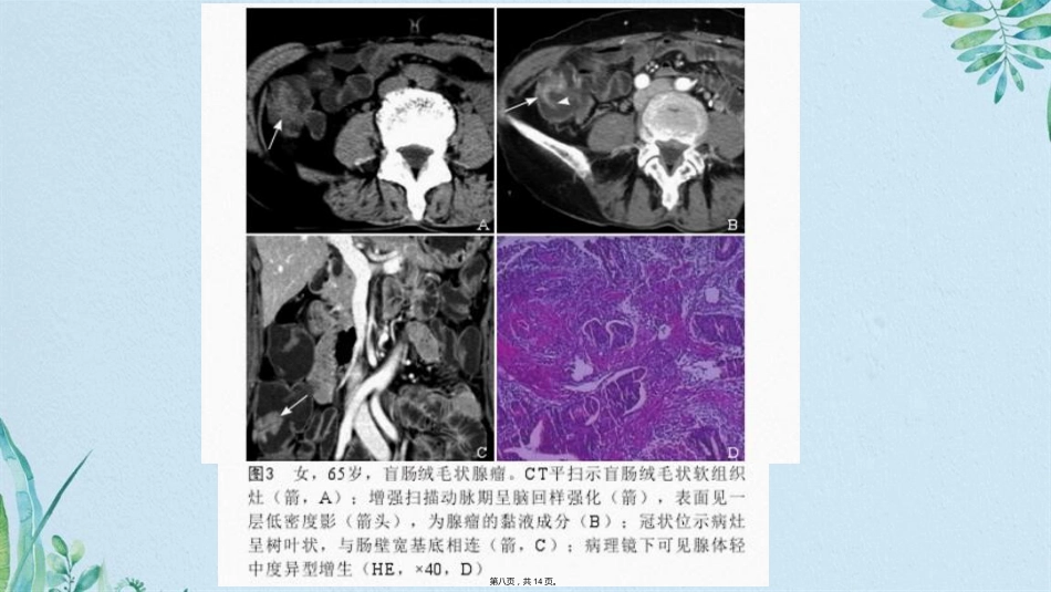肠腺瘤影像_第8页