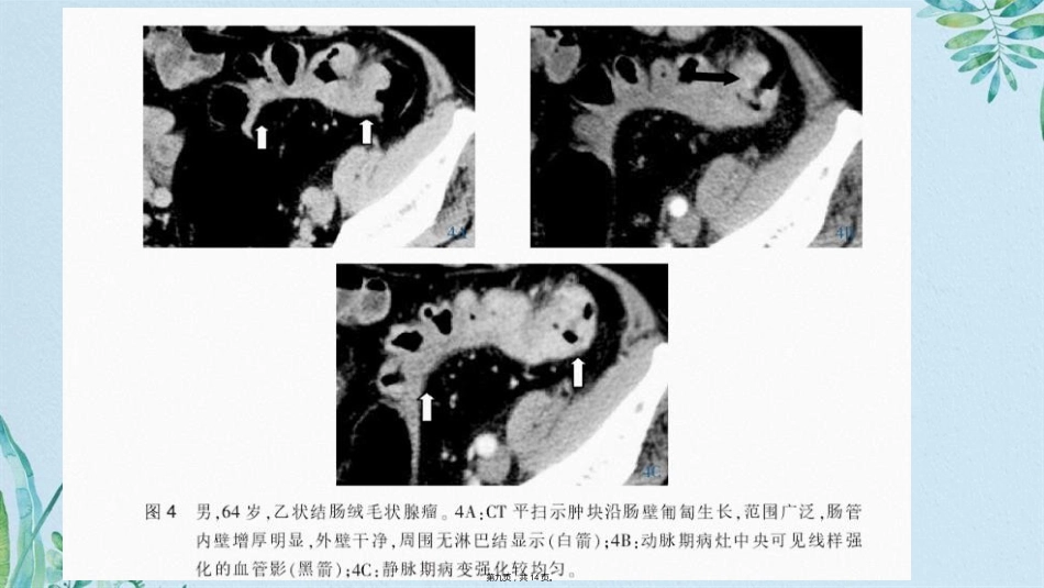 肠腺瘤影像_第9页