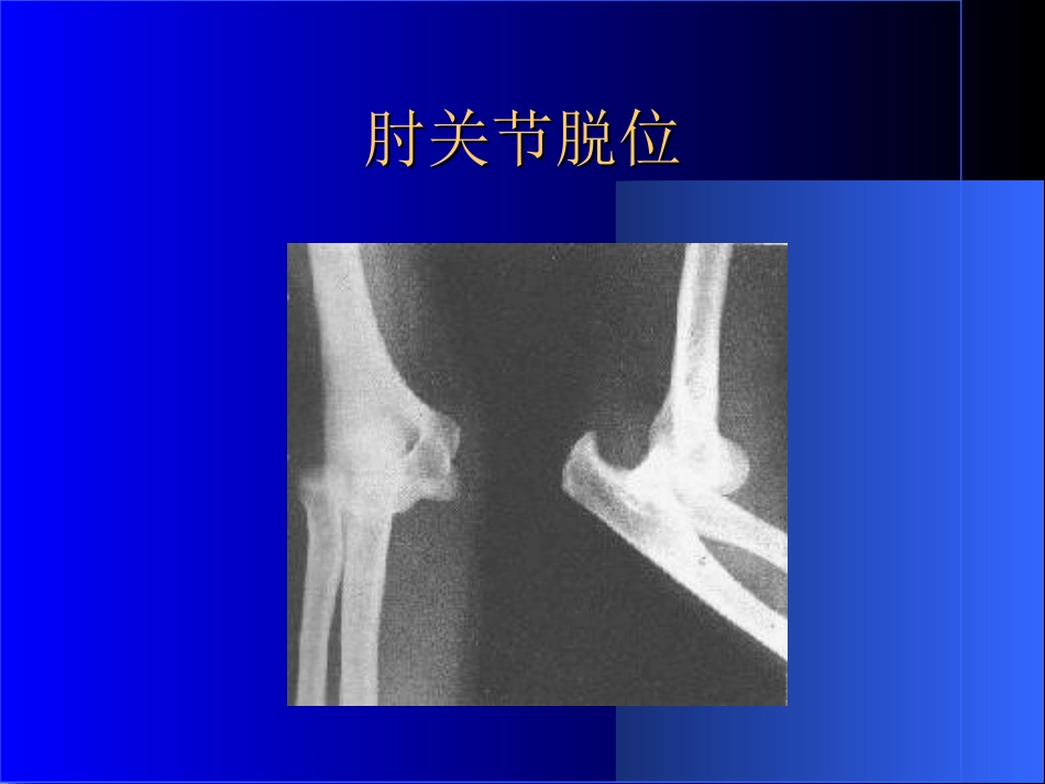 外影像与诊断学：骨科常见疾病的X线表现_第10页