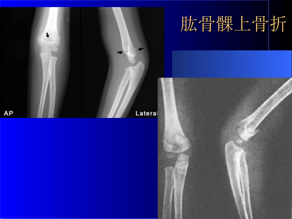外影像与诊断学：骨科常见疾病的X线表现_第11页