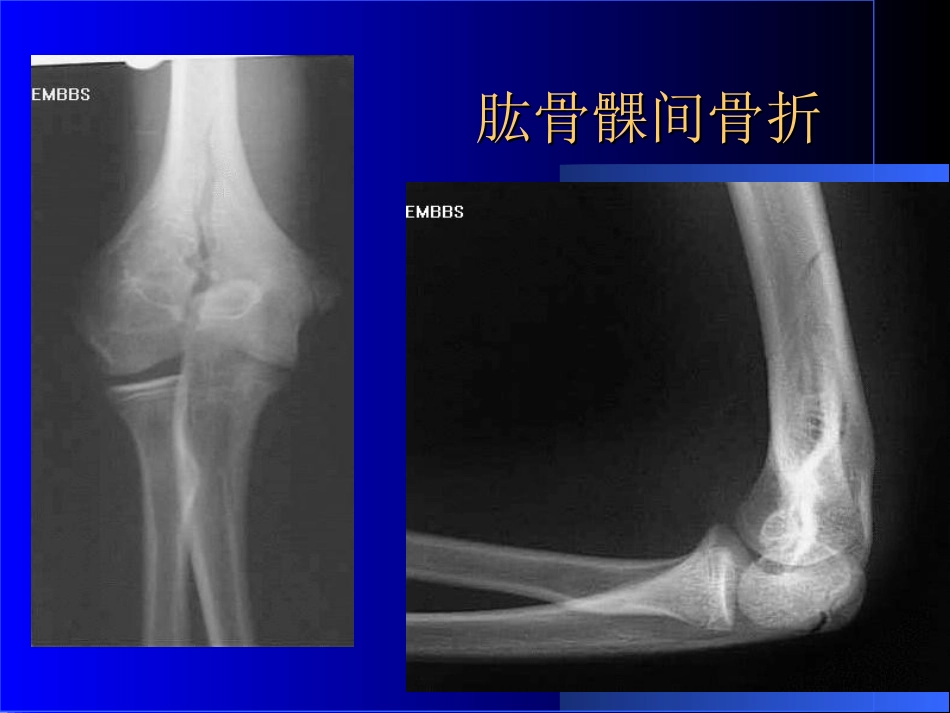 外影像与诊断学：骨科常见疾病的X线表现_第12页