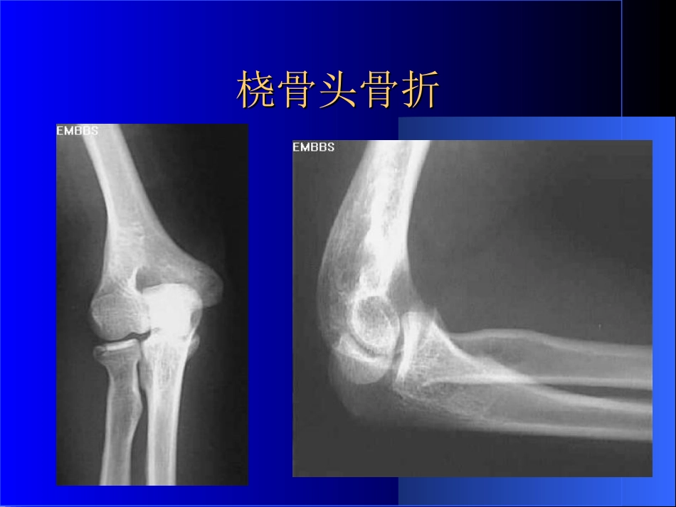 外影像与诊断学：骨科常见疾病的X线表现_第13页