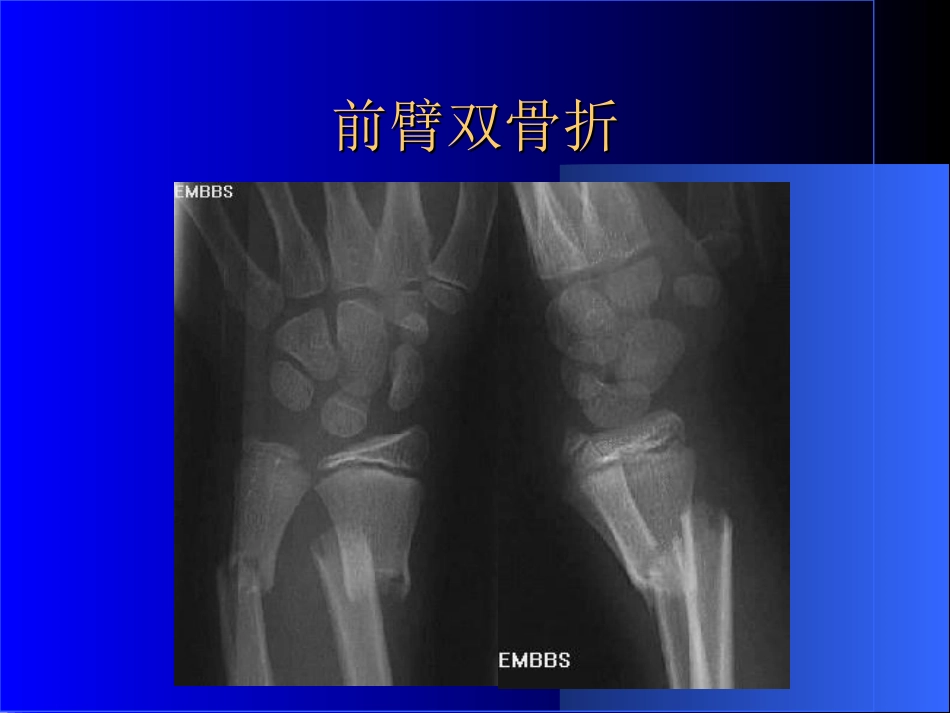 外影像与诊断学：骨科常见疾病的X线表现_第14页