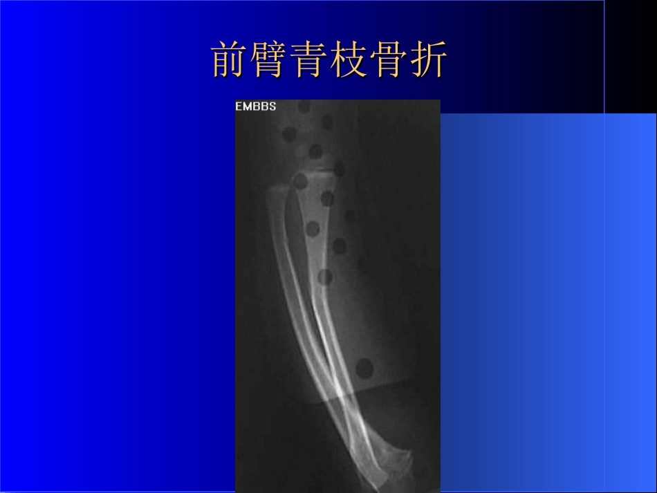 外影像与诊断学：骨科常见疾病的X线表现_第15页