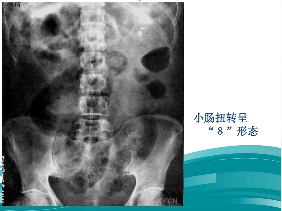 肠梗阻的影像诊断课件_第12页