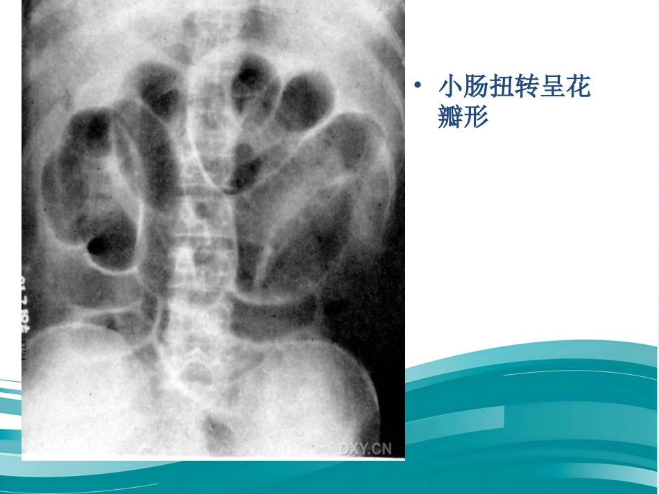 肠梗阻的影像诊断课件_第13页
