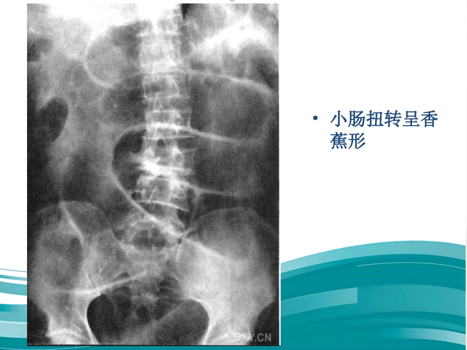 肠梗阻的影像诊断课件_第14页