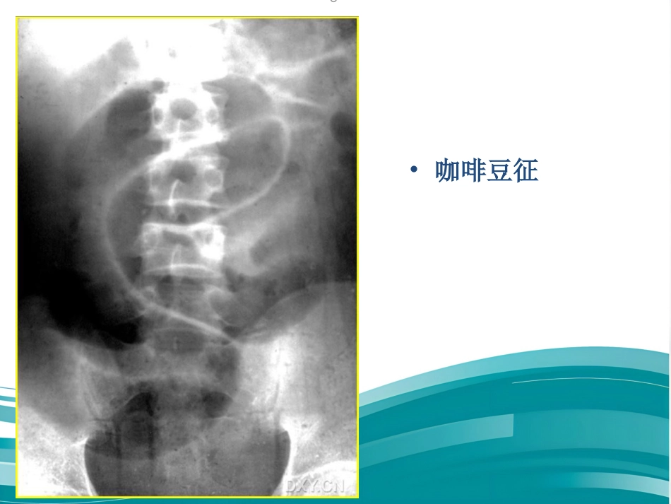 肠梗阻的影像诊断课件_第15页