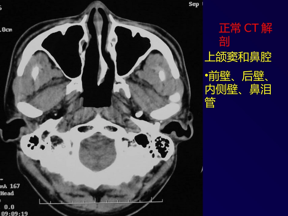 鼻和副鼻窦肿瘤影像诊断PPT幻灯片课件_第11页