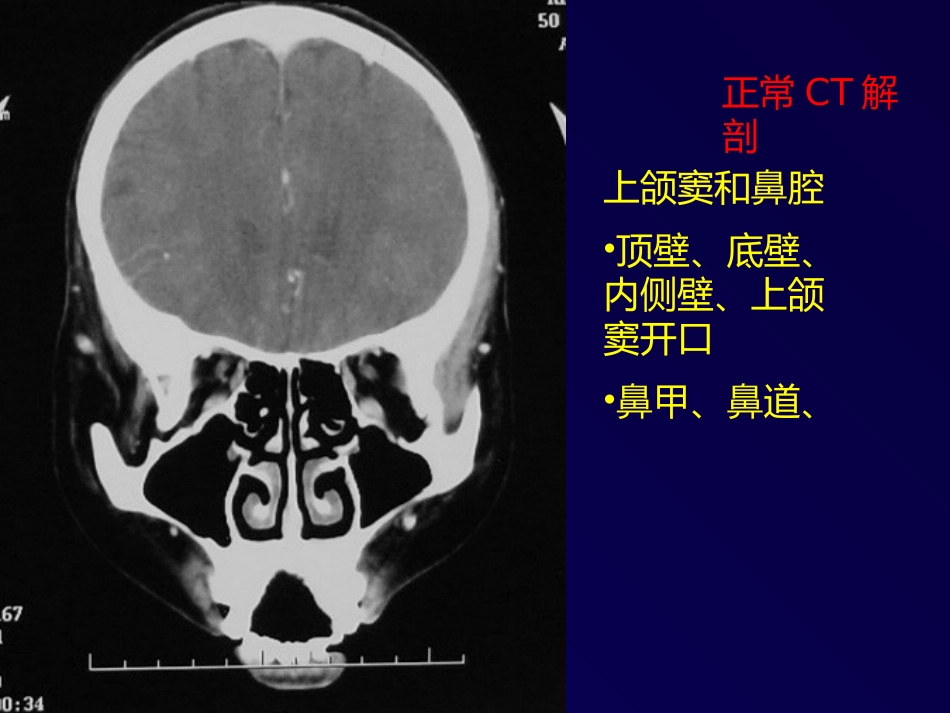 鼻和副鼻窦肿瘤影像诊断PPT幻灯片课件_第12页