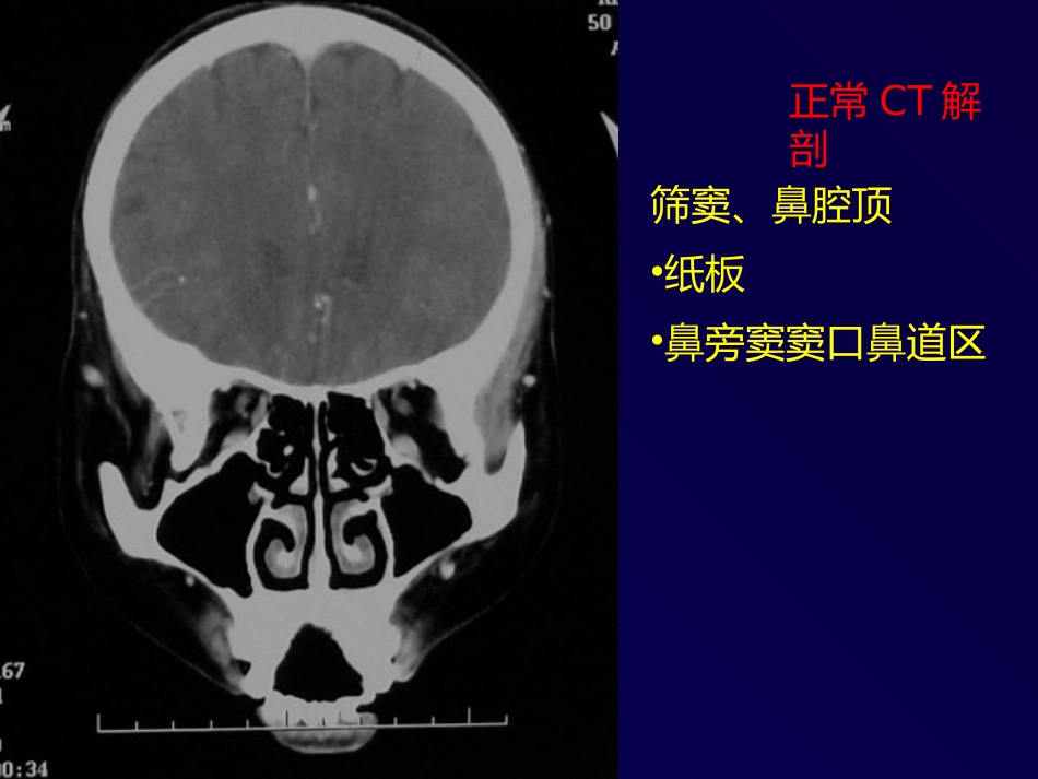 鼻和副鼻窦肿瘤影像诊断PPT幻灯片课件_第14页