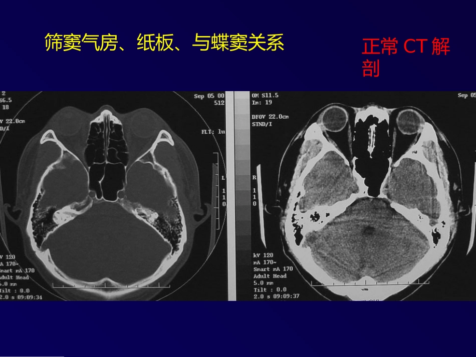 鼻和副鼻窦肿瘤影像诊断PPT幻灯片课件_第15页