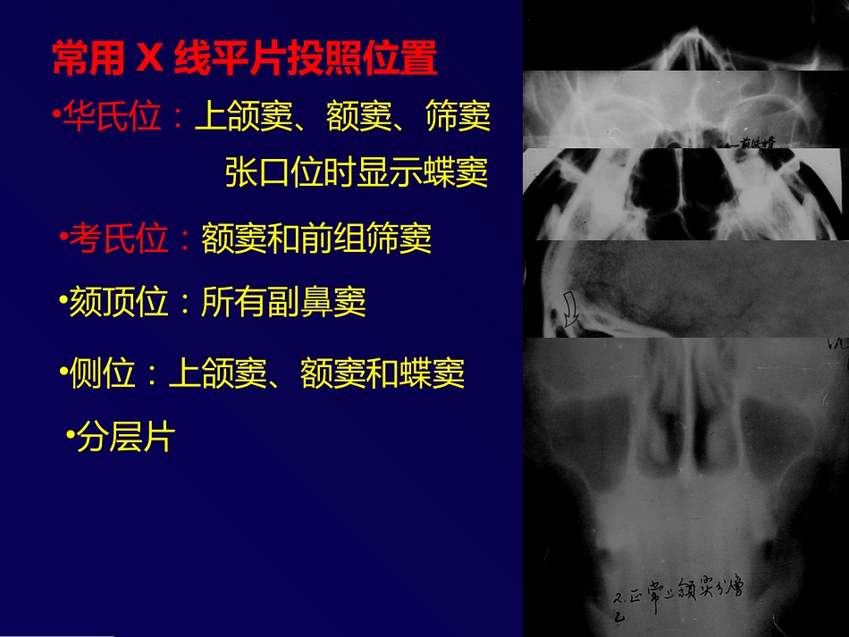 鼻和副鼻窦肿瘤影像诊断PPT幻灯片课件_第3页