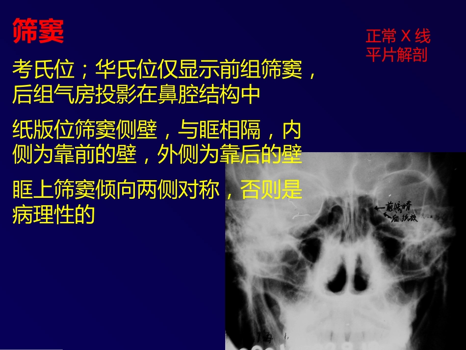 鼻和副鼻窦肿瘤影像诊断PPT幻灯片课件_第6页