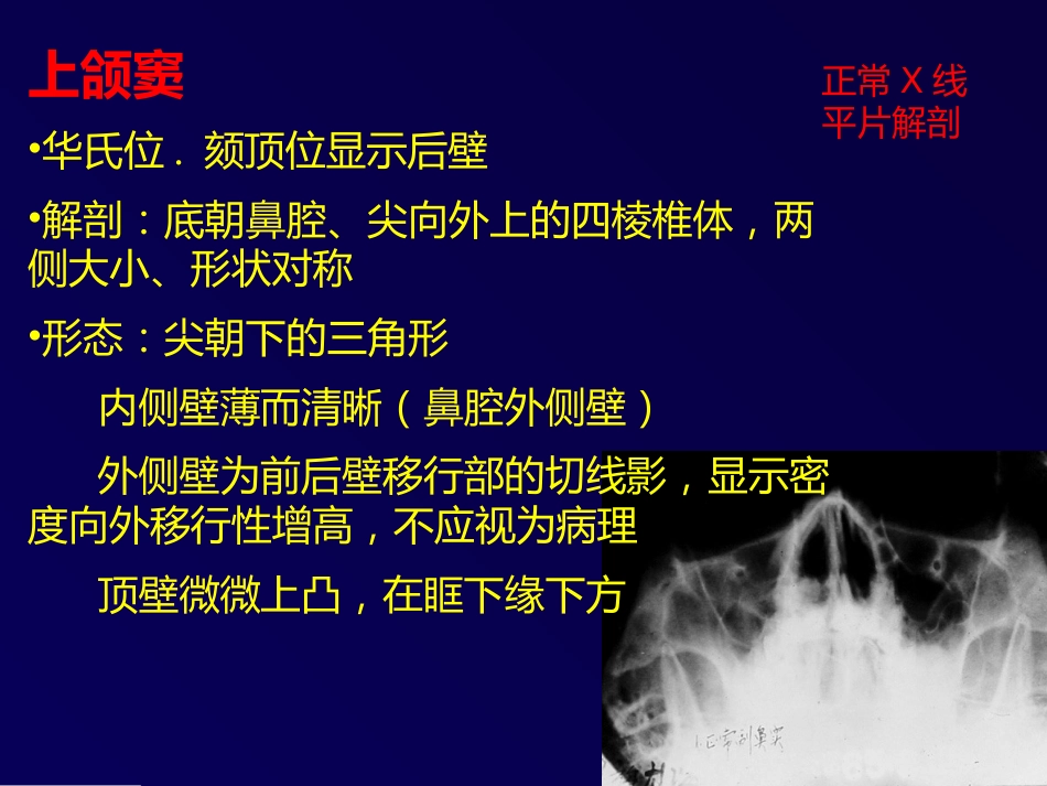 鼻和副鼻窦肿瘤影像诊断PPT幻灯片课件_第7页
