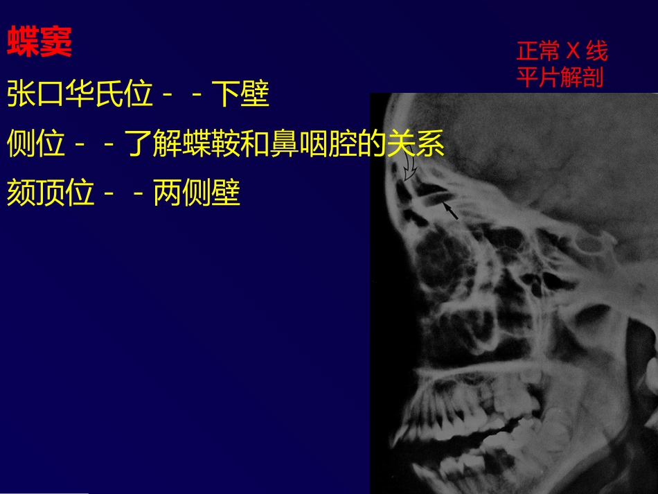 鼻和副鼻窦肿瘤影像诊断PPT幻灯片课件_第8页