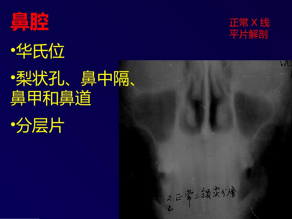 鼻和副鼻窦肿瘤影像诊断PPT幻灯片课件_第9页