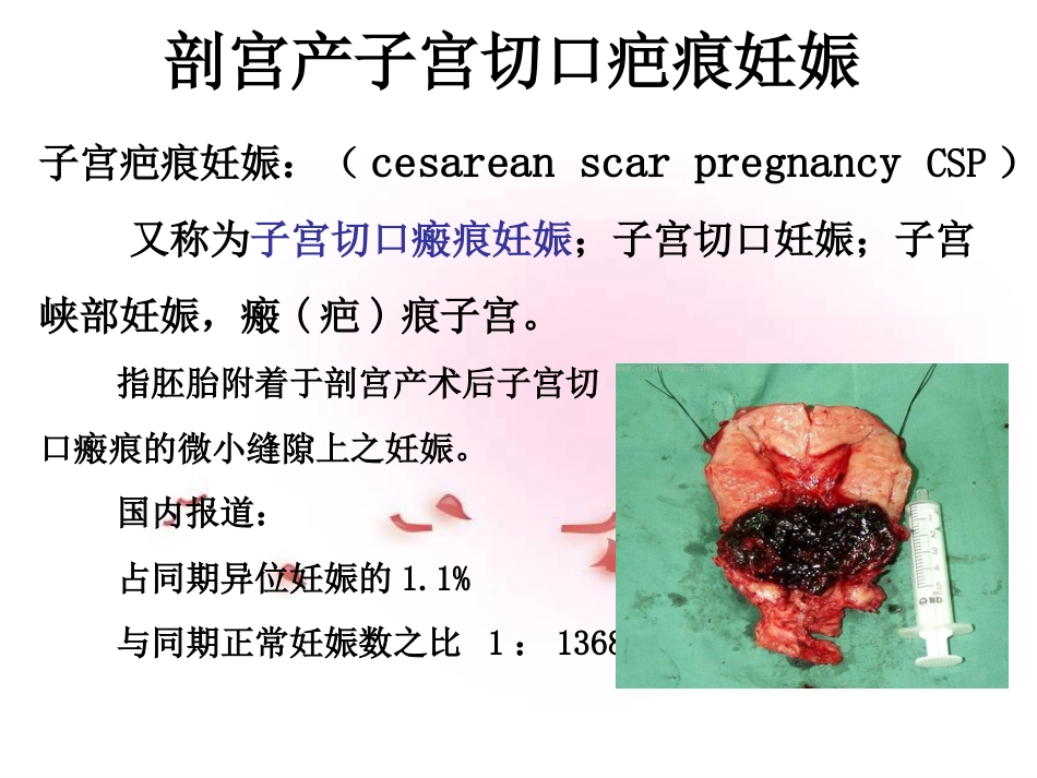疤痕妊娠的影像学诊断PPT课件_第3页