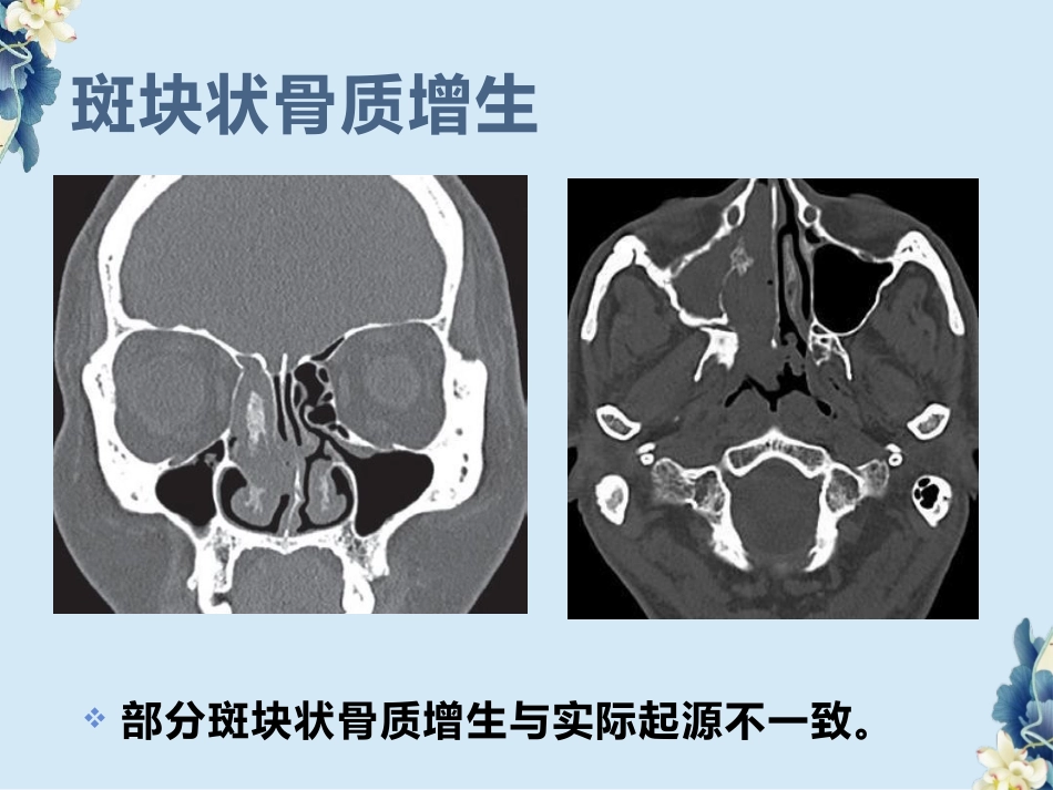 鼻腔鼻窦内翻性RU头状瘤(SNIP)的影像诊断与鉴别诊断_第10页