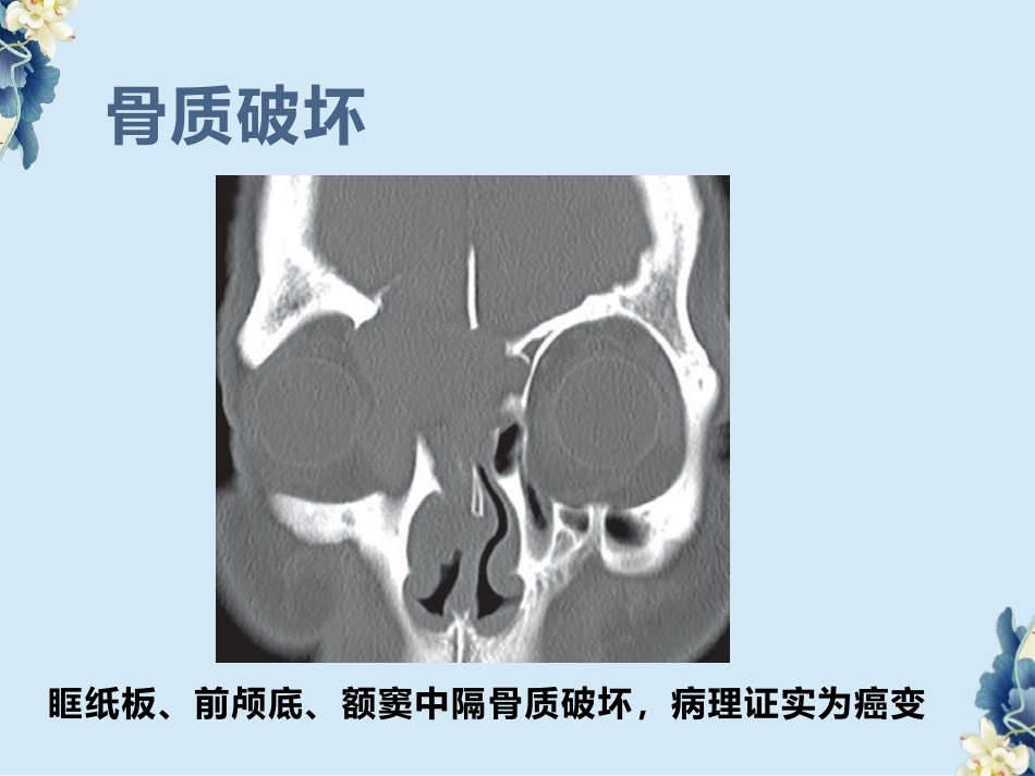 鼻腔鼻窦内翻性RU头状瘤(SNIP)的影像诊断与鉴别诊断_第11页