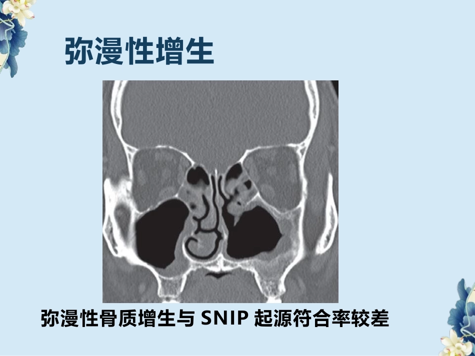 鼻腔鼻窦内翻性RU头状瘤(SNIP)的影像诊断与鉴别诊断_第12页