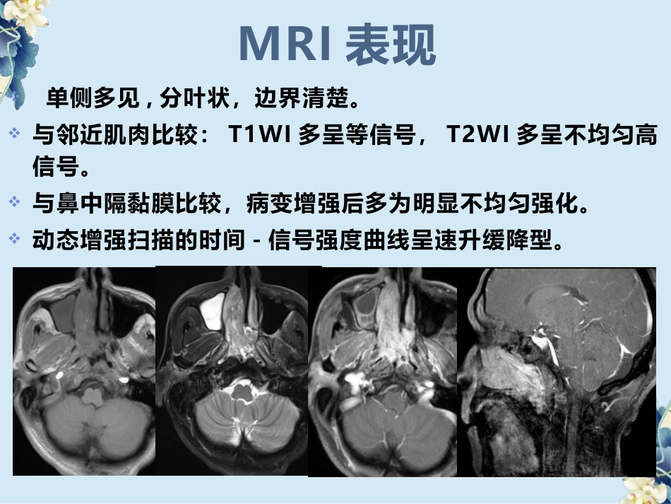 鼻腔鼻窦内翻性RU头状瘤(SNIP)的影像诊断与鉴别诊断_第13页