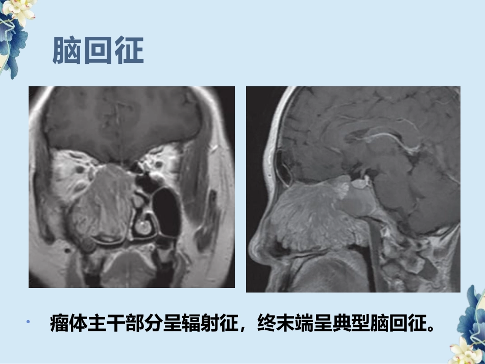 鼻腔鼻窦内翻性RU头状瘤(SNIP)的影像诊断与鉴别诊断_第15页