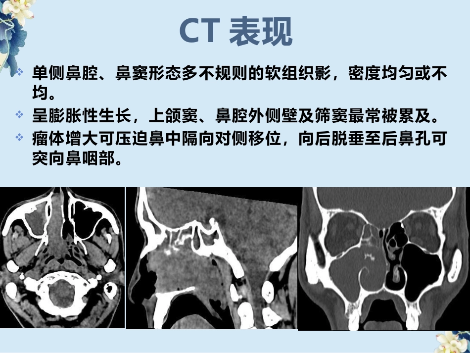 鼻腔鼻窦内翻性RU头状瘤(SNIP)的影像诊断与鉴别诊断_第6页