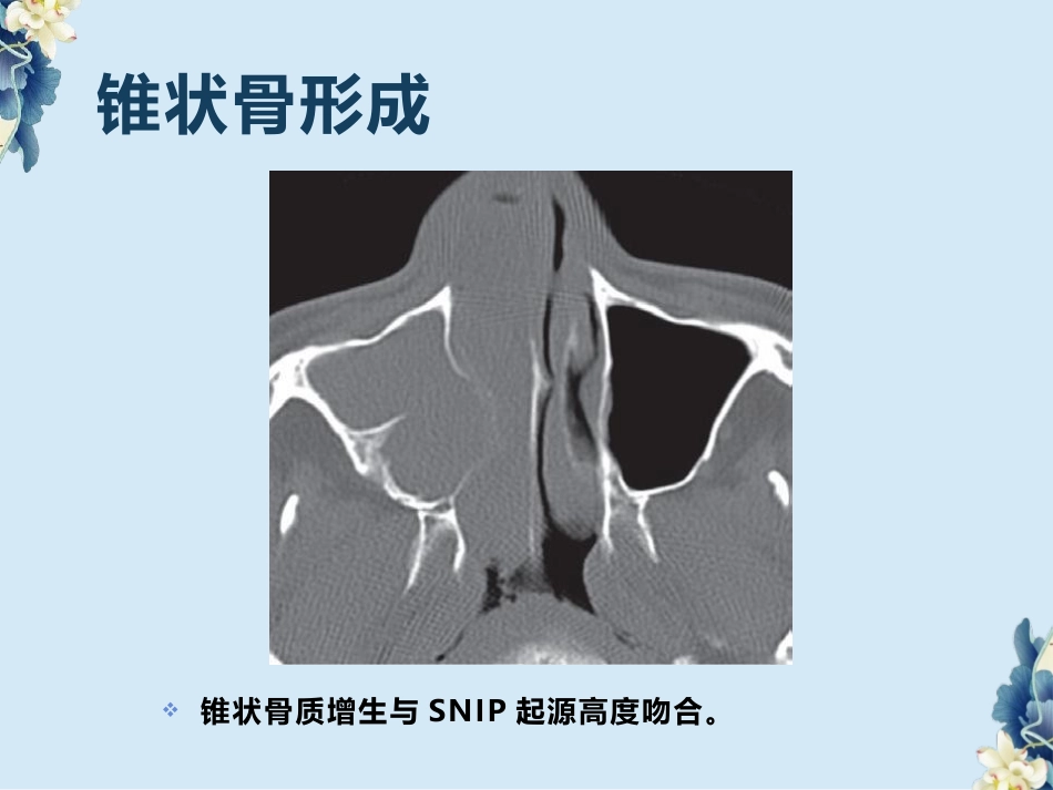 鼻腔鼻窦内翻性RU头状瘤(SNIP)的影像诊断与鉴别诊断_第8页