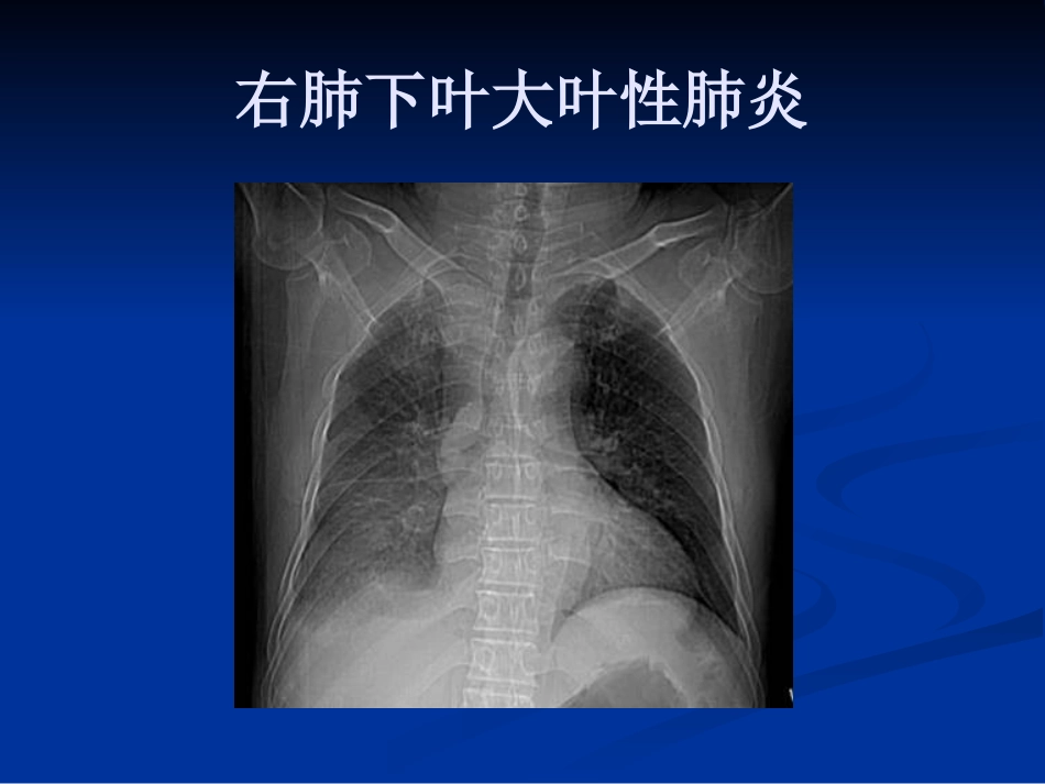常见肺炎的影像诊断_第11页