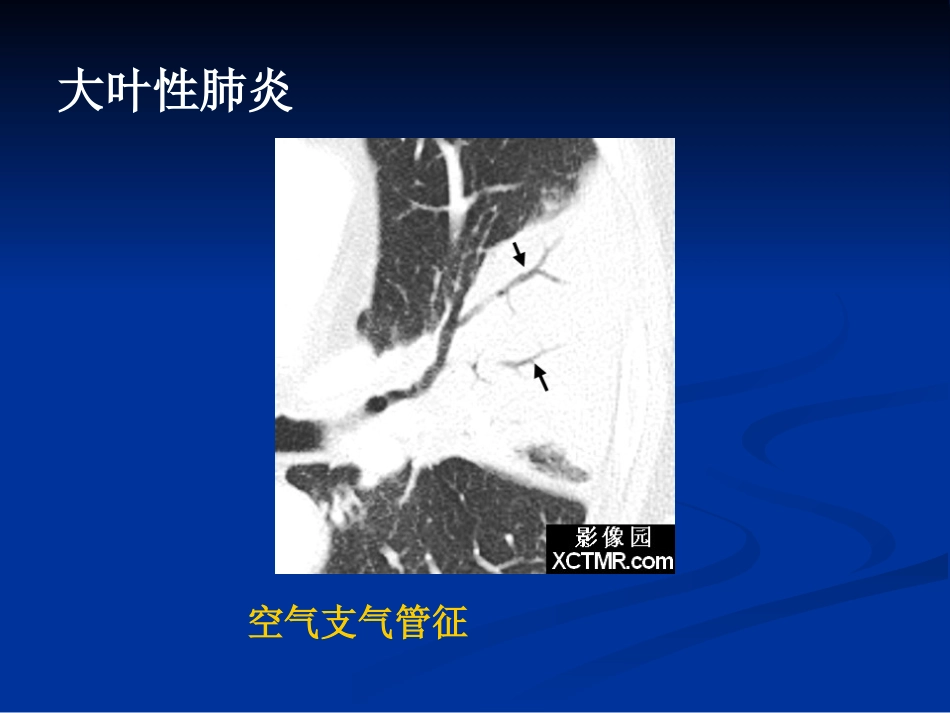 常见肺炎的影像诊断_第13页