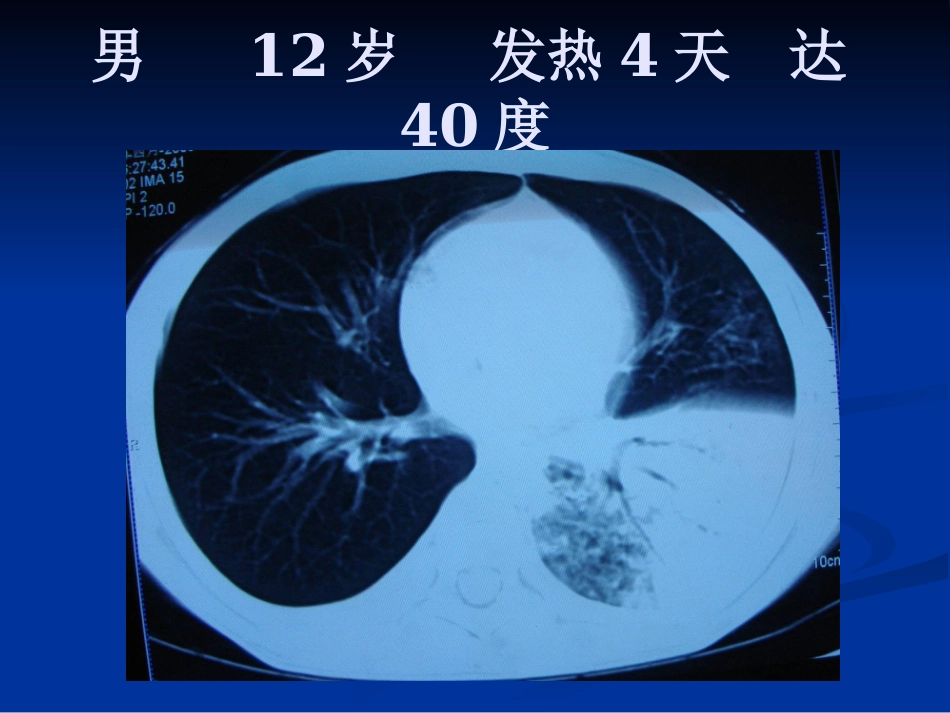 常见肺炎的影像诊断_第15页